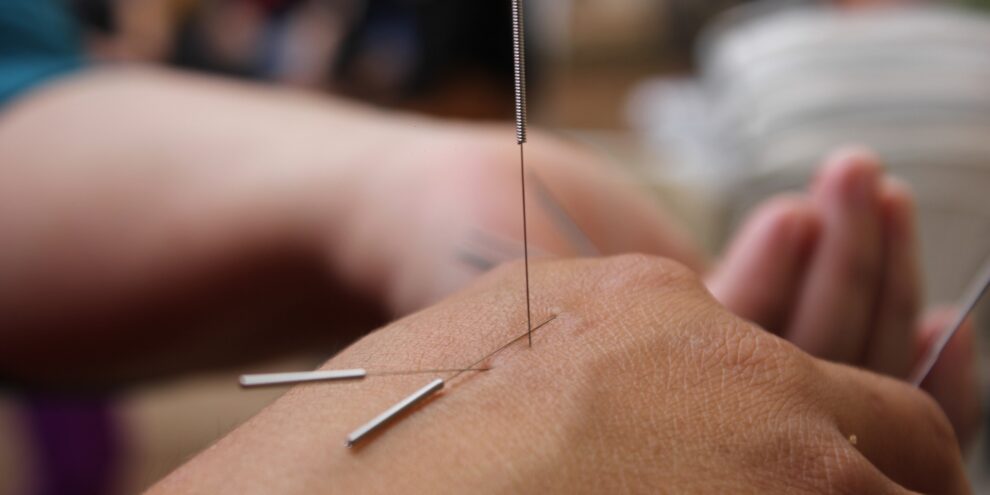 acupuncture-g16c803e45_1920